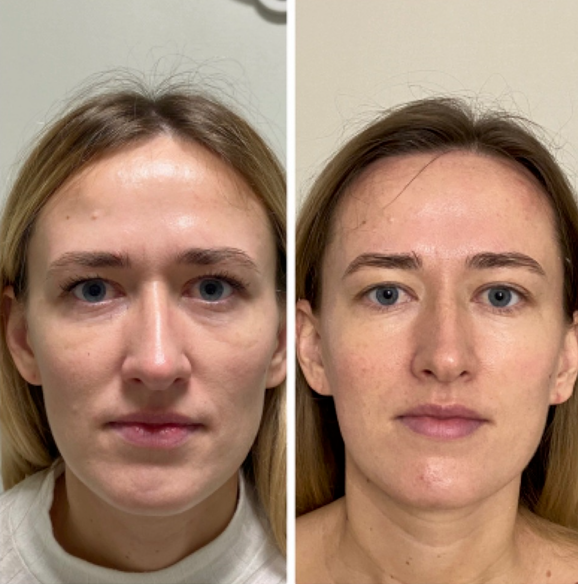 Resultados del masaje facial